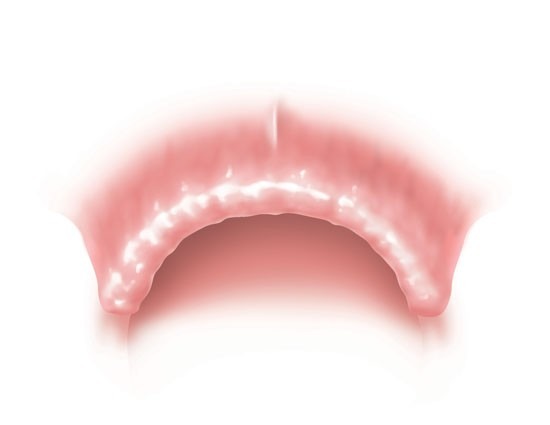 Fixed-Implant-Supported-Porcelain-Bridges-1