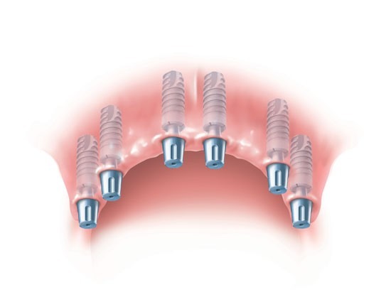 Fixed-Implant-Supported-Porcelain-Bridges-2