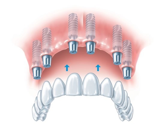 Fixed-Implant-Supported-Porcelain-Bridges-3