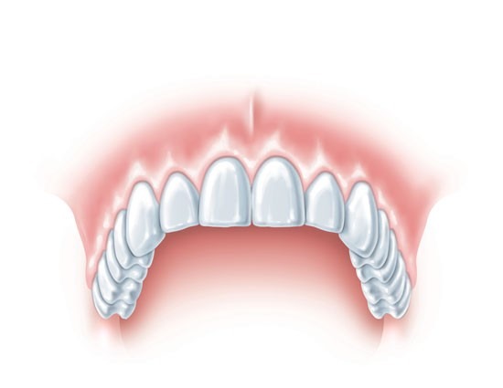 Fixed-Implant-Supported-Porcelain-Bridges-4