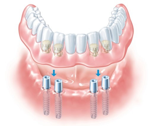 Implant-Retained-Dentures-3