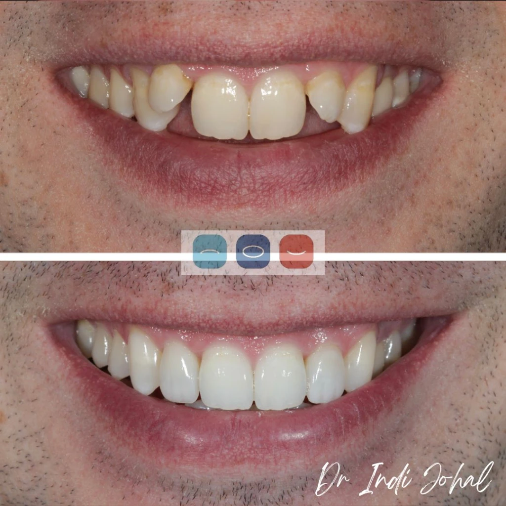 invisalign-before-after-01