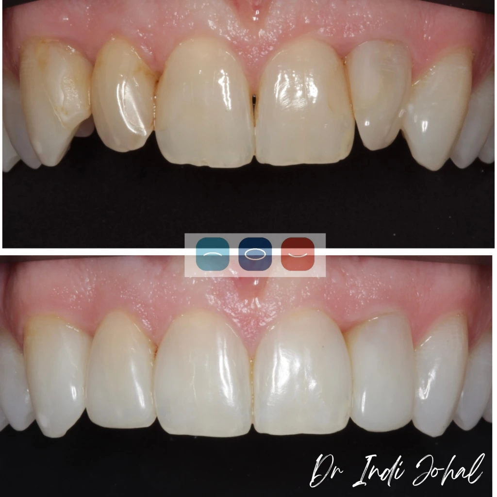 invisalign-before-after-02