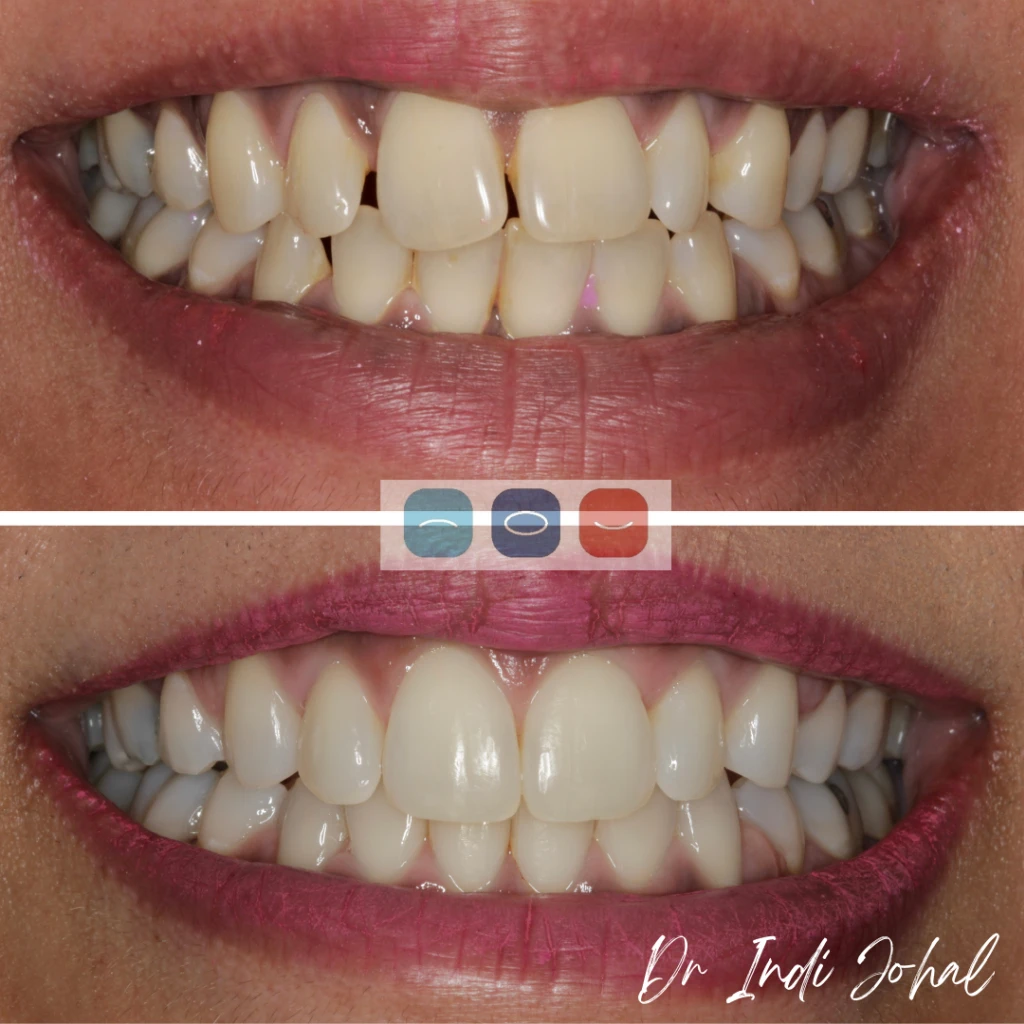 invisalign-before-after-03