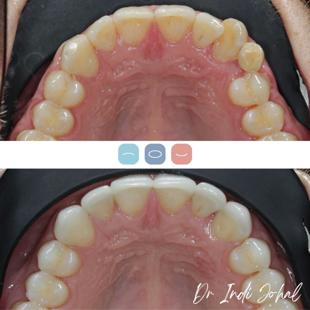 invisalign-before-after-04